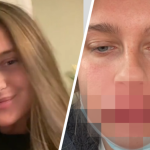 powiększanie ust skutki uboczne