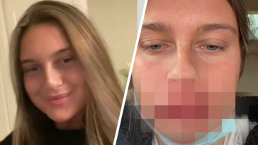 powiększanie ust skutki uboczne