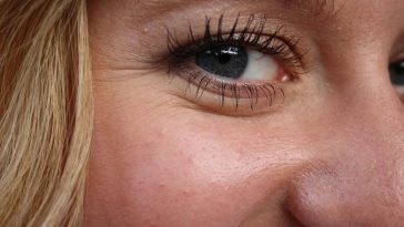 zmarszczki na twarzy rodzaje choroby