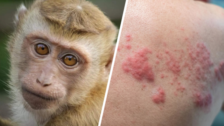 małpia ospa co to jest objawy