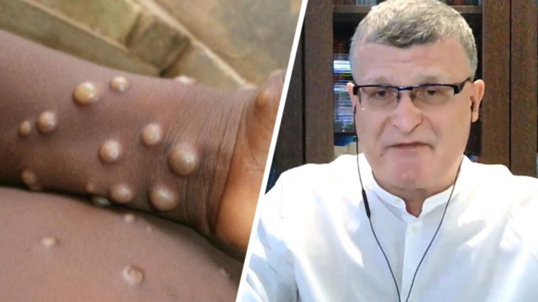 małpia ospa w polsce