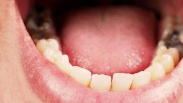 od czego psują się zęby u dzieci