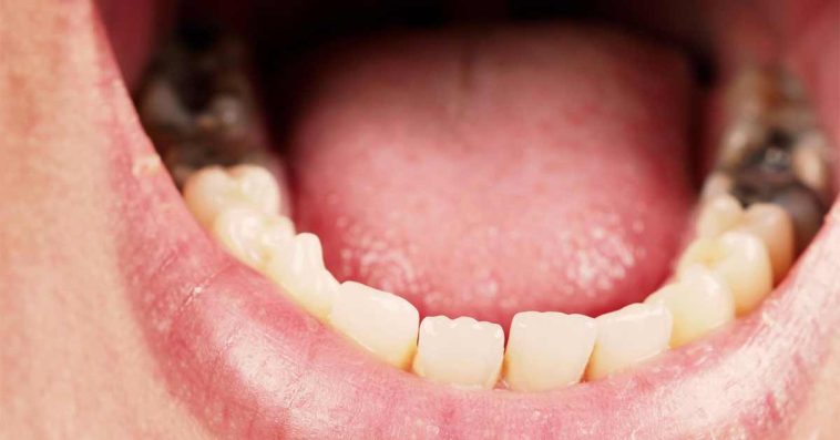 od czego psują się zęby u dzieci