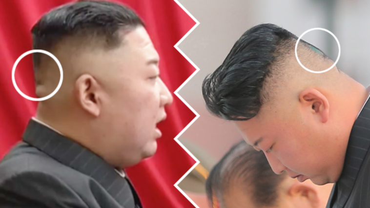 kim dzong un choroba