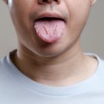 candida auris w polsce objawy