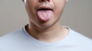 candida auris w polsce objawy