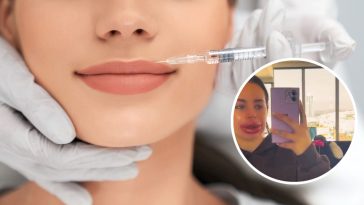 powiększanie ust czy jest bezpieczne