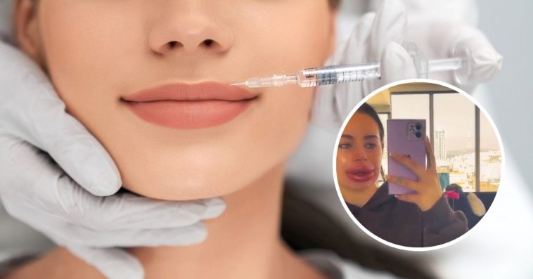 powiększanie ust czy jest bezpieczne