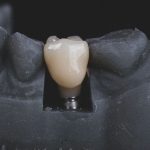 zakładanie licówek jak wygląda zabieg