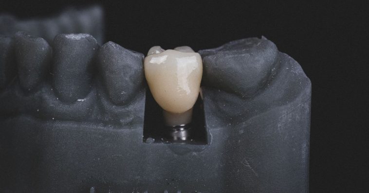 zakładanie licówek jak wygląda zabieg