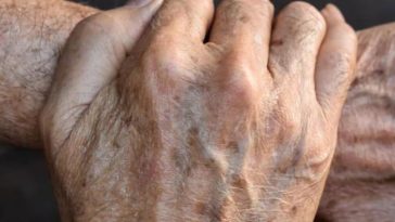 starcze plamy jak się pozbyć