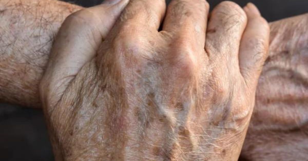 Te plamki na skórze ma większość seniorów. Wystarczą dwie rzeczy, by je usunąć