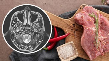 wągrzyca mózgu objawy