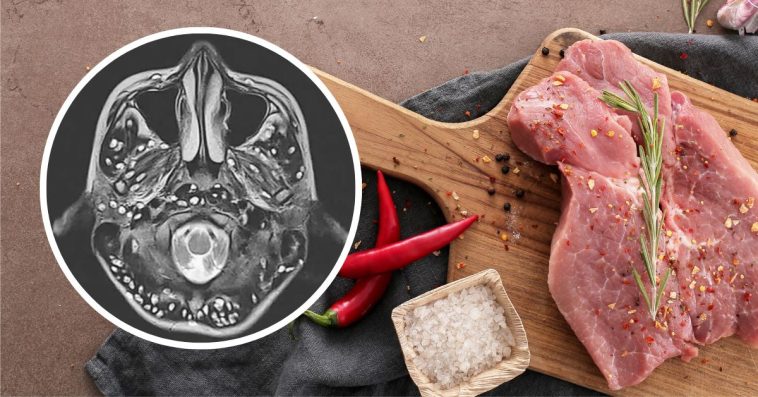 wągrzyca mózgu objawy