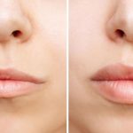 Powiększanie ust Łódź cena