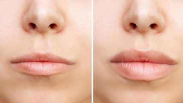 Powiększanie ust Łódź cena