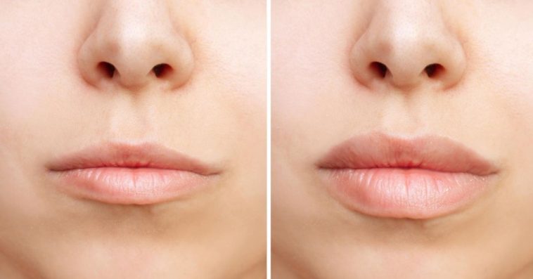 Powiększanie ust Łódź cena