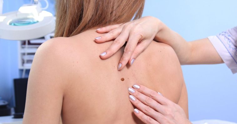 usuwanie znamion warszawa gdzie najlepiej