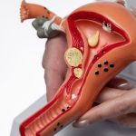 endometrioza a ciąża leczenie