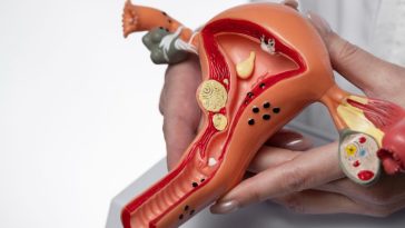 endometrioza a ciąża leczenie