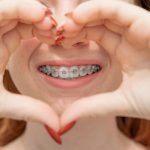 aparat na zęby a całowanie się