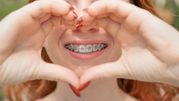 aparat na zęby a całowanie się