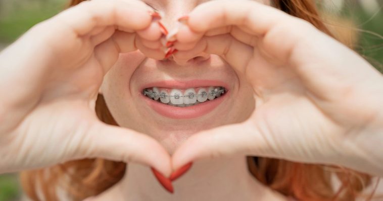 aparat na zęby a całowanie się