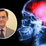 epidemia udarów mózgu