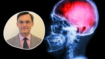 epidemia udarów mózgu