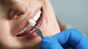 implanty zębów forum