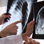 rak płuc objawy forum