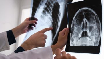 rak płuc objawy forum