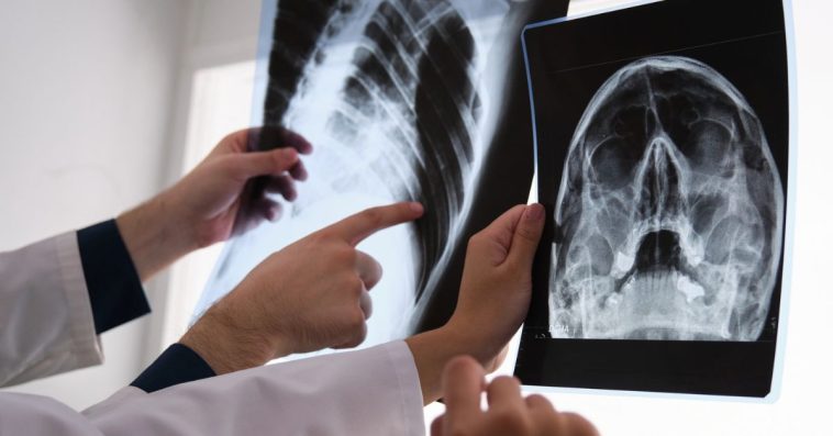 rak płuc objawy forum