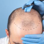 przeszczep włosów turcja przed i po