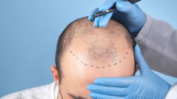 przeszczep włosów turcja przed i po