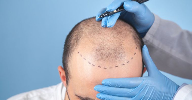 przeszczep włosów turcja przed i po