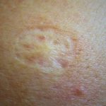 czemu po szczepionce jest slad