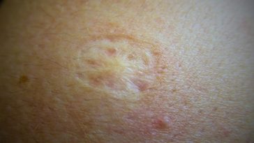 czemu po szczepionce jest slad