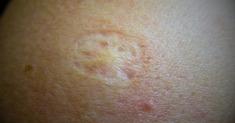 czemu po szczepionce jest slad