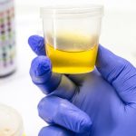 leukocyty w moczu co oznaczają