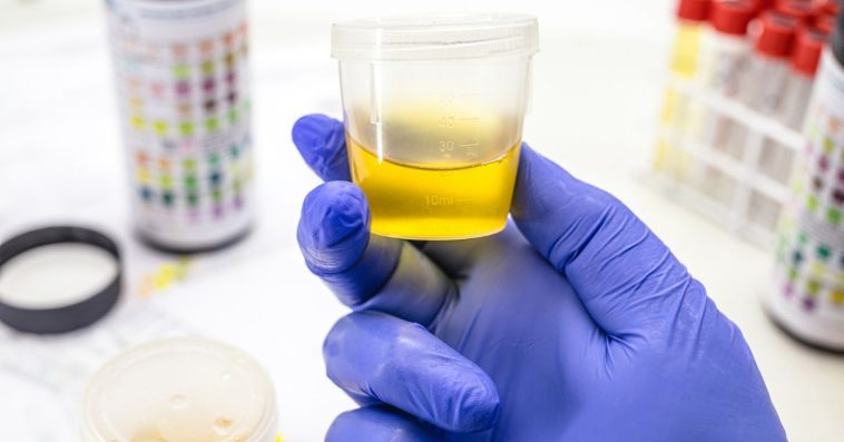 leukocyty w moczu co oznaczają