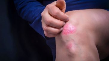 co oznacza jak swedzi kolano lewe prawe przesady