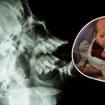 zespół graysona wikipedia