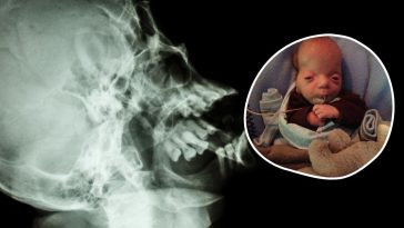 zespół graysona wikipedia