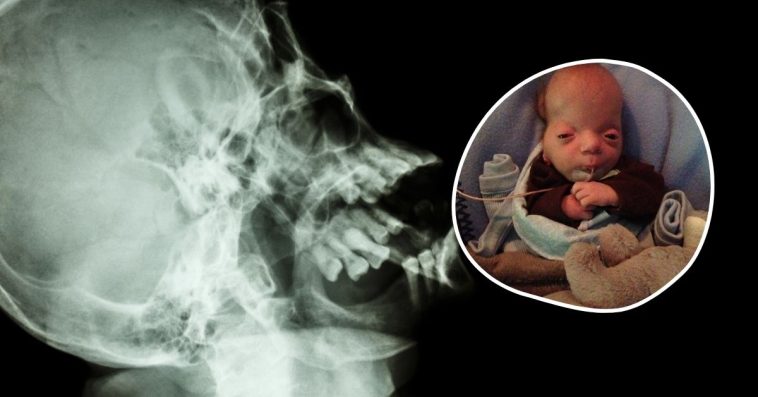 zespół graysona wikipedia