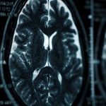 mgła mózgowa objawy przyczyny co to