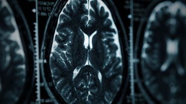 mgła mózgowa objawy przyczyny co to