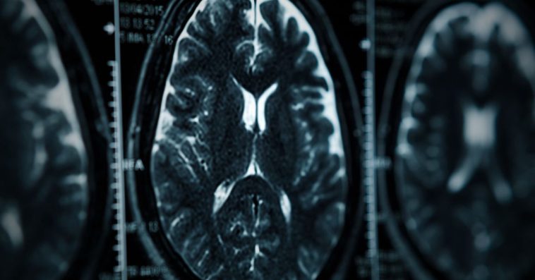 mgła mózgowa objawy przyczyny co to