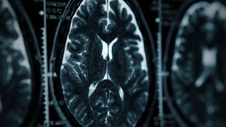 mgła mózgowa objawy przyczyny co to