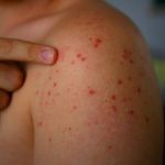 odra choroba objawy zdjęcia